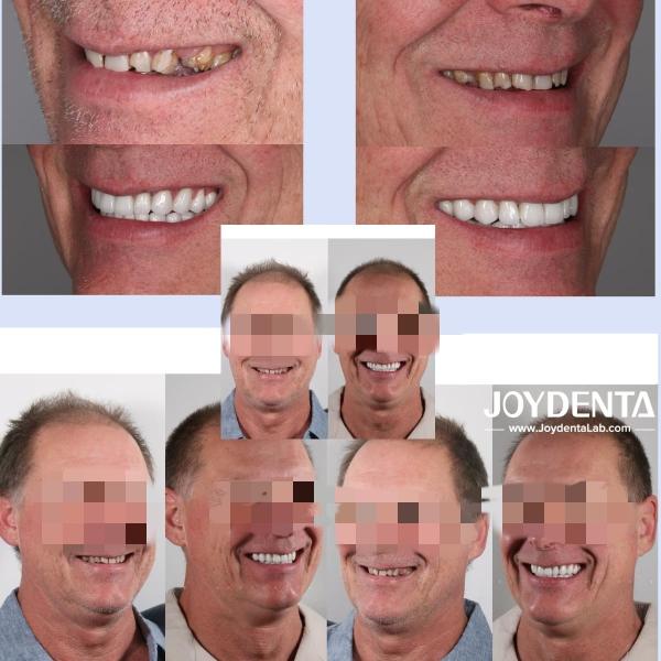 Prothèses en zirconium qui imitent les dents naturelles