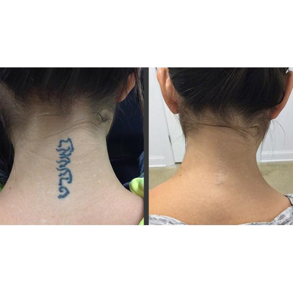 Air Cooling ND YAG Laser Tattoo Removal Machine 750ps High Peak Power