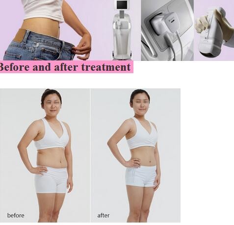 Advanced Diode Laser Machine Liposonix Body Slimming Equipment