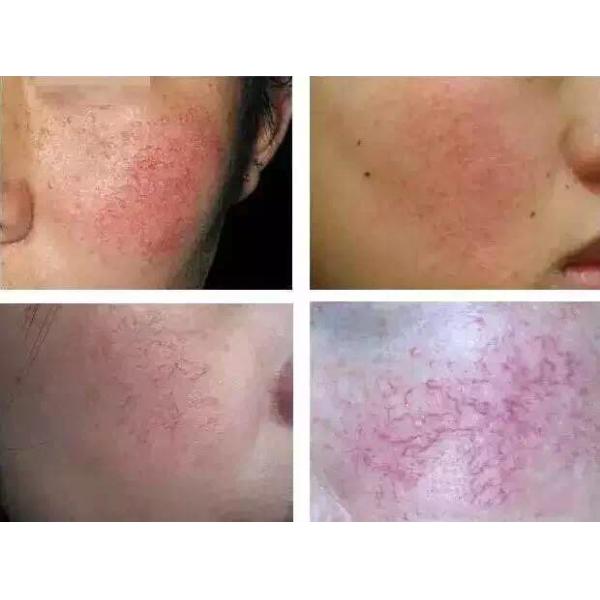 машина вены потока удаления 20W лазера диода 10-260ms 980nm васкулярная