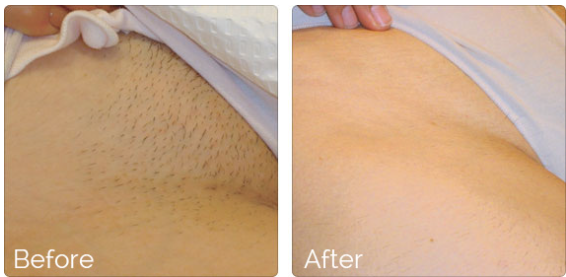 808nm Laser Hair Removal Machine 10 Germany Laser Depilator