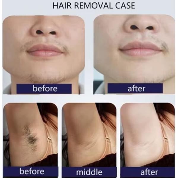 Eliminación de vello con láser de diodo Rejuvenecimiento de la piel Máquina de belleza Pico láser 2 en 1