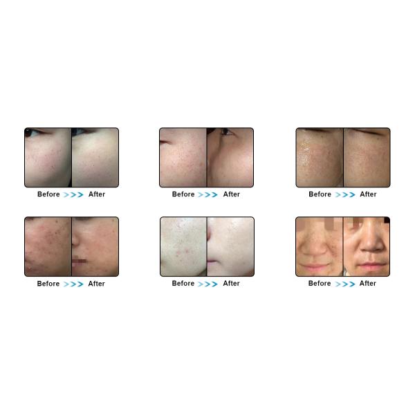 Photorejuvenation угорь удаления волос IPL HR elight DPL машина красоты постоянного лицевая многофункциональная