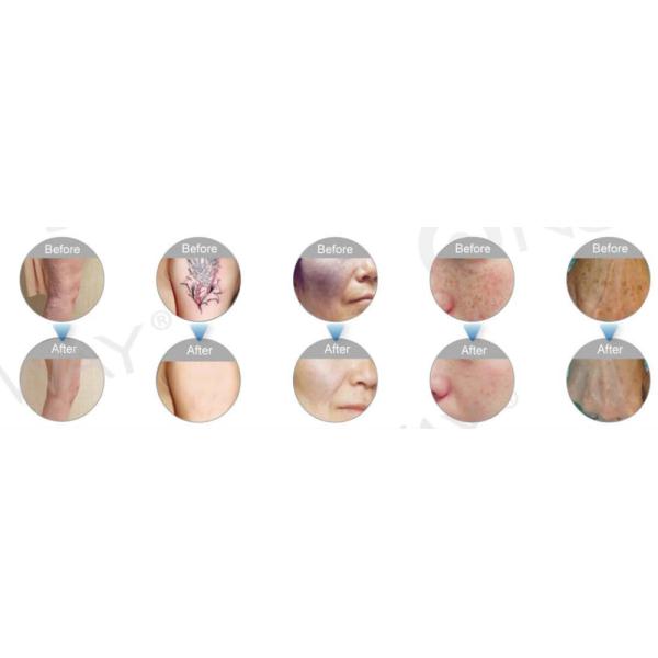 Hot Q-switched Nd-yag Laser Tattoo Machine/ 1064nm 532nm Mole Skin Tag Removal & Tattoo