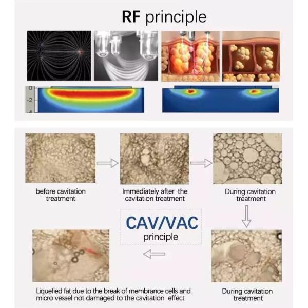 6 In 1 Monopolar Vacuum 40k Cavitation Machine For Weight Loss Skin Tightening