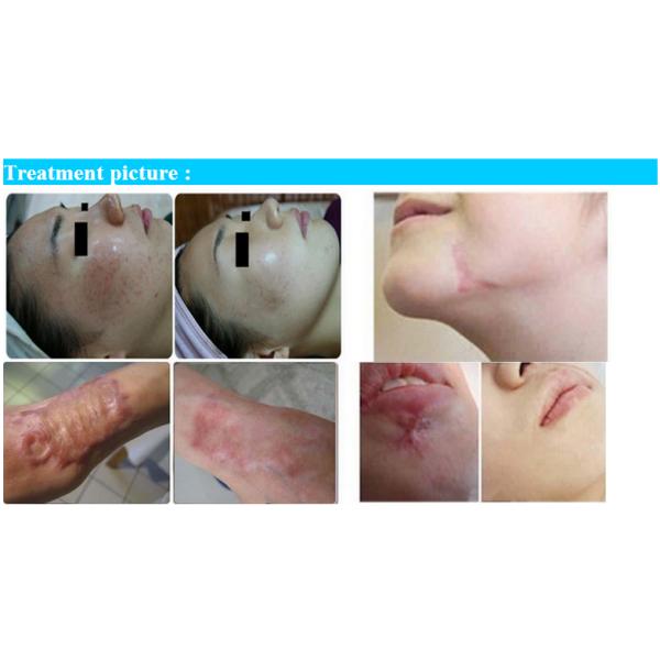 10600nm Fractional Co2 Laser Machine For Scars Removal / Skin Rejuvenation
