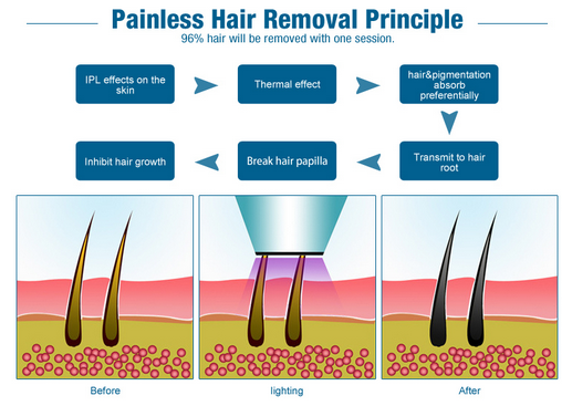 удаление волос лазера для машины удаления волос лазера светлых волос личной