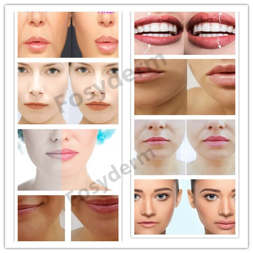 Заполнитель Fosyderm 1ml Derm стороны и губ извлекая морщинки