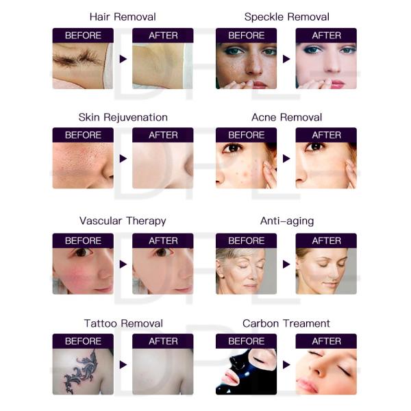 D-813 DPL OPT Laser Hair Removal Machine Epilator 1064nm Tatoo Removal