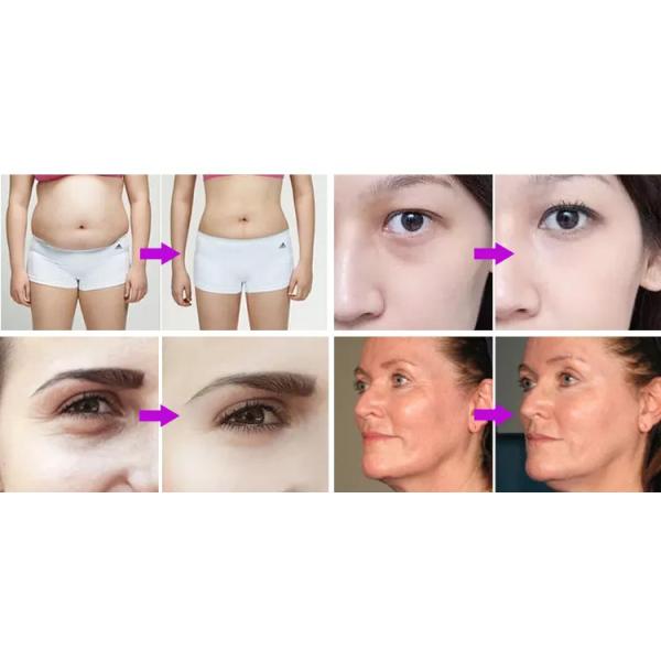 Machine de levage du visage non chirurgicale 120VA noire