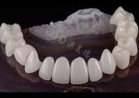 Dente Dental Translúcido Coroneta de Zircônio Sólido Estética Natural Resistência a Rasgaduras