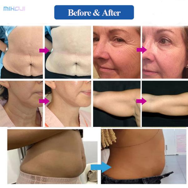 Adjustable 2 Handles Hifu 9D Machine Skin Tightening With 7 Cartridges