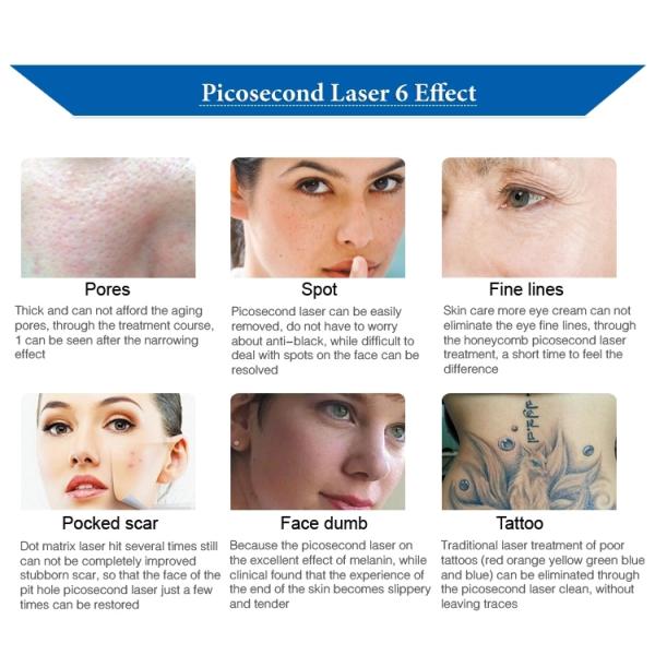 Машина удаления татуировки лазера Pico обработки кожи, лазер ND YAG переключателя 2000W q