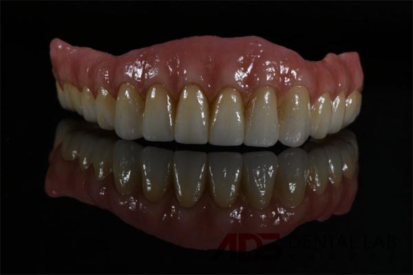 Titanium Zirconia Implant Supported Dental Bridge All On 4 6