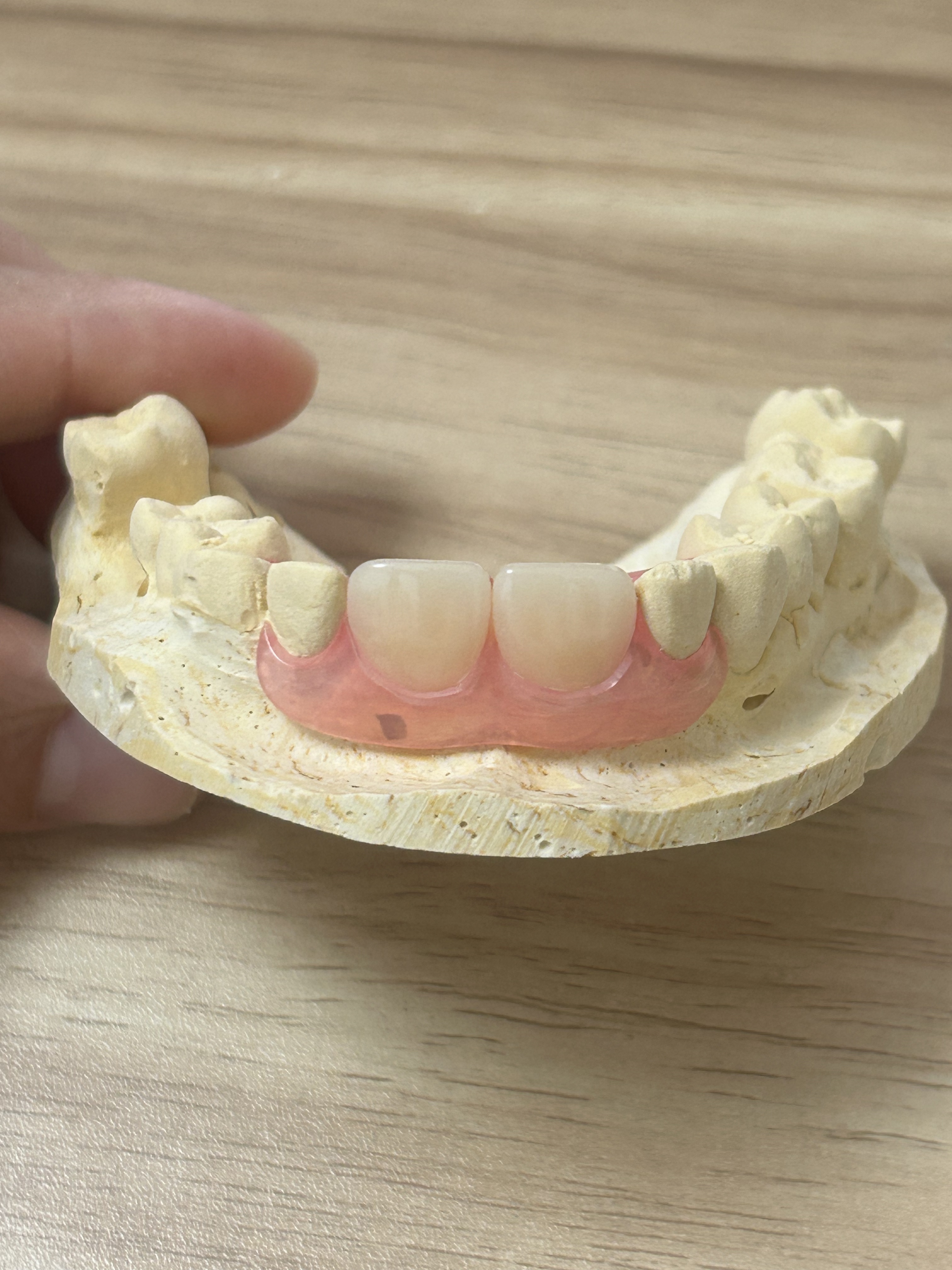 Lightweight Comfortable Discreet Appearance Removable Denture Base and Flexible Denture Base for Esthetic Partial Dentures