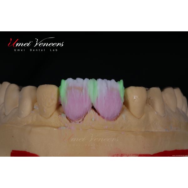 Natural White Cast Porcelain Veneers