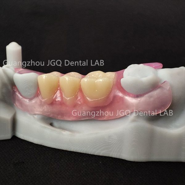 Valplast Flexible Denture Unique Material Flexibility Comfort Adapting to Mouth