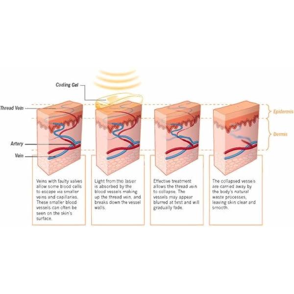 Машина удаления вен паука 20HZ 50W экран касания 8,4 дюймов