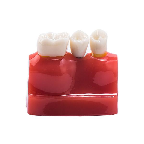 Class III Instrument Classification Dental Study Model for Dental Practice and Demonstration