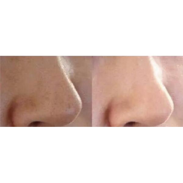 Dermabrasion машины/воды корки двигателя кислорода/гидро dermabrasion Microdermabrasion