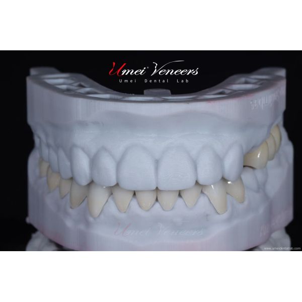 Strong and thin aesthetic veneers