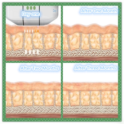 Best Facial Skin Lifting Wrinkel Remover Ultrasound HIFU/ Portable HIFU Slimming Machine