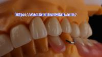 Couronne dentaire en zircone et pont translucide 3D PRO couronne en porcelaine en zircone