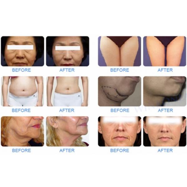 Жирная горящая кавитация Rf подтяжки лица вакуумирует уменьшение машины