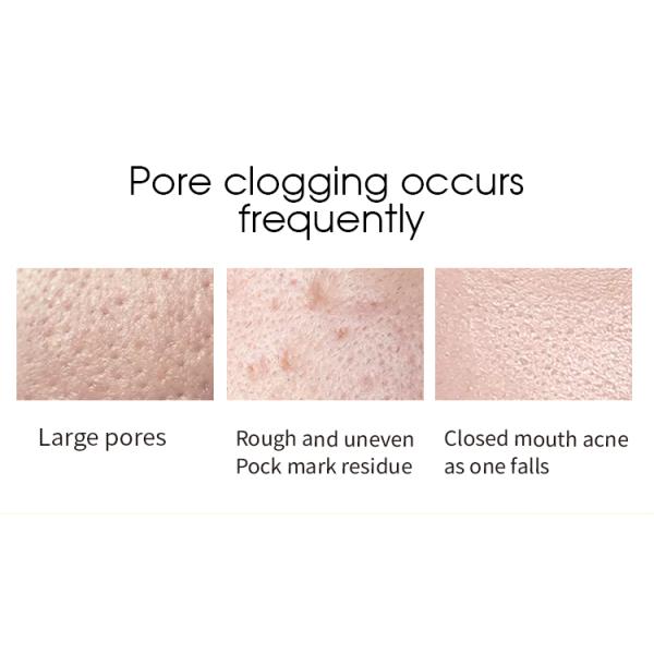 Poros faciales de hidratación ácidos salicílicos del ODM de la tinta que minimizan la tinta