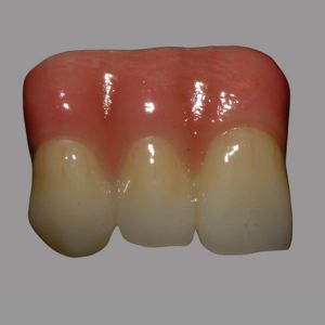 Zirconia Bridge