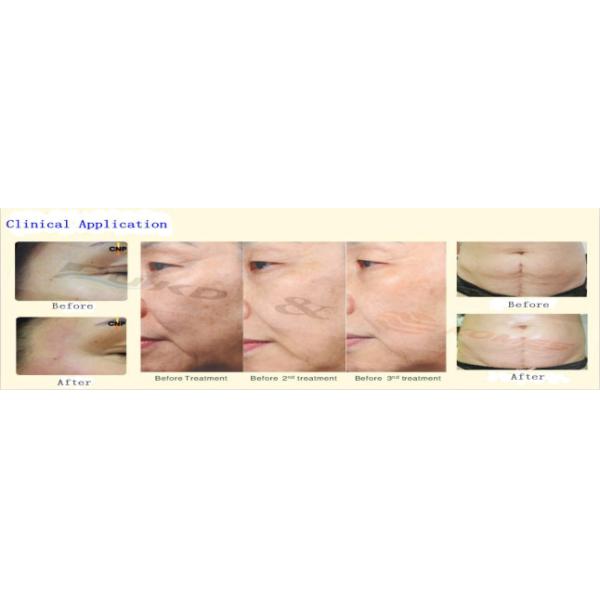 CE Skin Resurfacing RF Fractional Laser Equipment for Woman , Professional 2MHz