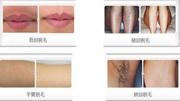 2016 new design champange color SHR hair removal IPL remove hair machine with CE approval