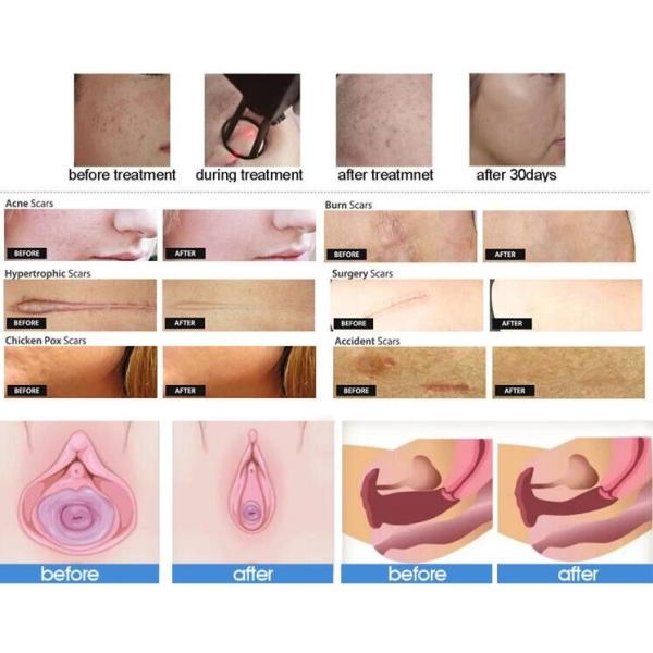Scar Removal Fractional CO2 Laser Beauty Equipment With 10.4 Inch LCD Touch Screen