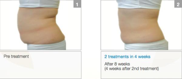 LED Light Professional 4 handpiece cryolipolysis fat freezing / cryolipolysis slimming machine