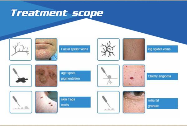 High Frequency 30MHz Effective Vascular Spider Vein Removal Machine For Sale