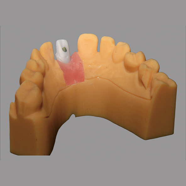 White Custom Zirconia Abutment Natural Looking For Dental Restoration