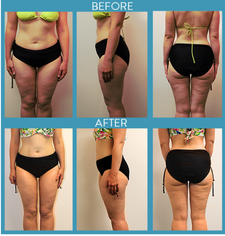 Home Use HIFU Beauty Machine Body Slimming  46mm * 46mm Single Shot Area