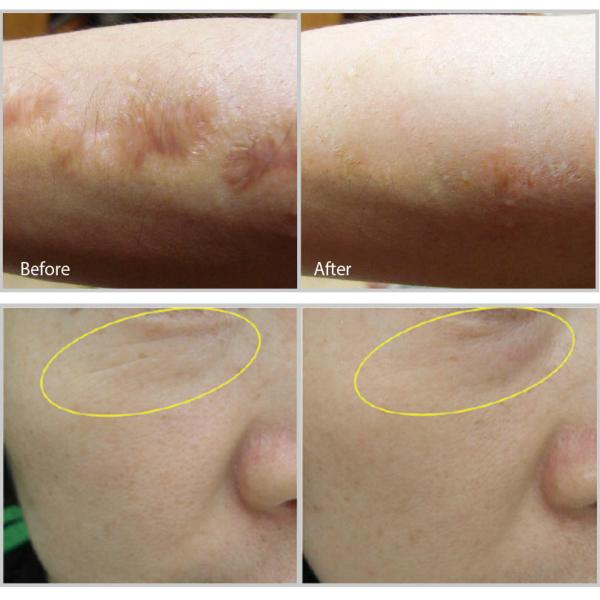 Medical Laser Vaginal Rejuvenation Machine 40W - 75W Power 35x35x107cm Size