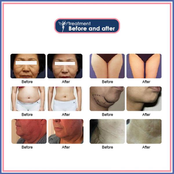 Кожа стороны поднимая влагалищное затягивая уменьшение тела обработки машины HIFU