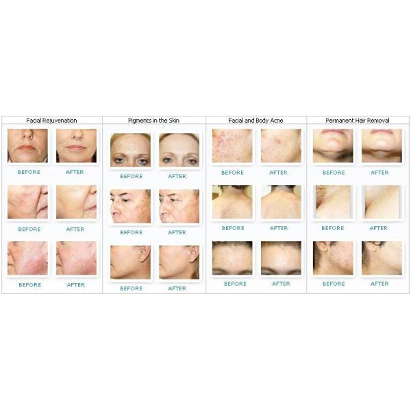 Máquina Laser Ipl para el hogar 530nm - 1200nm para el rejuvenecimiento de la piel y la eliminación de arrugas