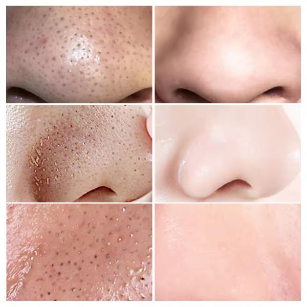 Remover Cabeças Negras Serum Facial Natural Orgânico Anti- Envelhecimento Reparação Serum Cuidado da Pele