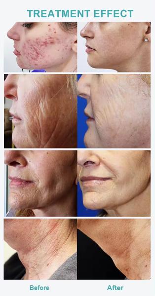 Beauty Facial Spa Wrinkle Removal Skin Tightening Meso Needles Mesotherapy No-needle Mesotherapy Device Mesotherapy Gun