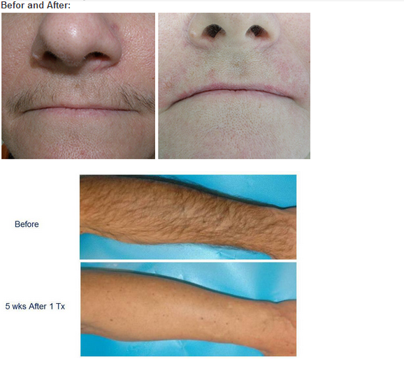 Painless 808nm Diode Permanent Laser Hair Removal Machine 5 - 1500ms Adjustable