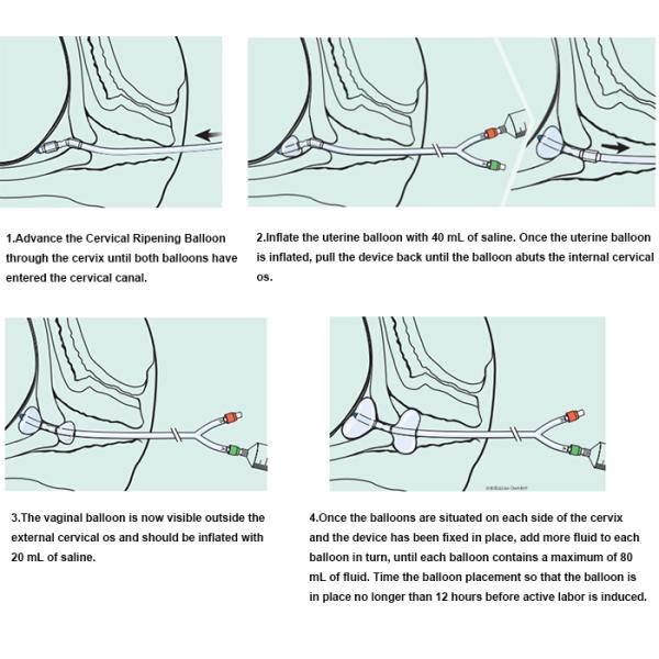 18Fr Gynecology Urology Disposable Products Silicone Cervical Ripening Balloon