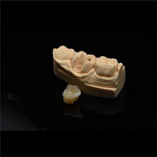 Metal Free Composite Crowns Inlays And Onlays Bridges Implants ODM