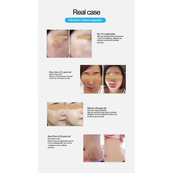 Машина Thermage портативная Rf частичная Microneedle Monopolar RF Microneedling OEM