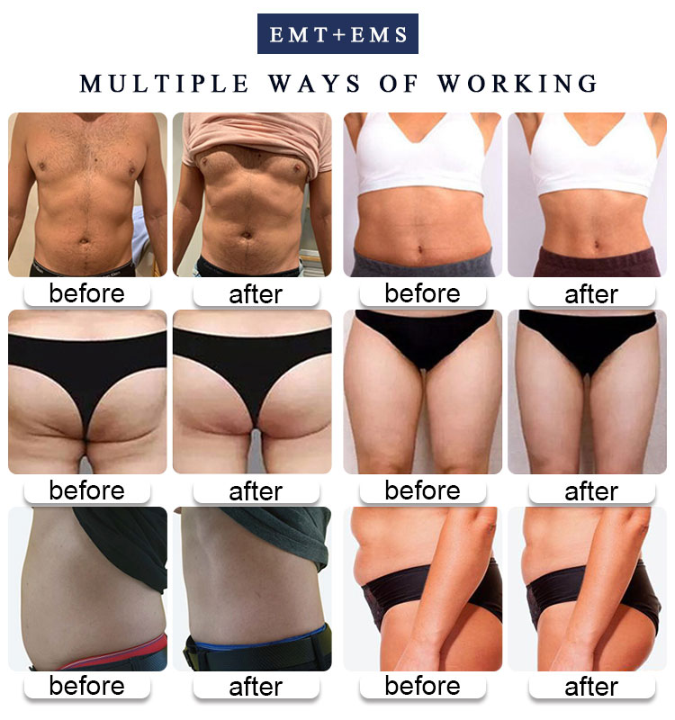 Body Contouring Muscle Building Belly Fat Removal EMS HIEMT Body Sculpting Machine
