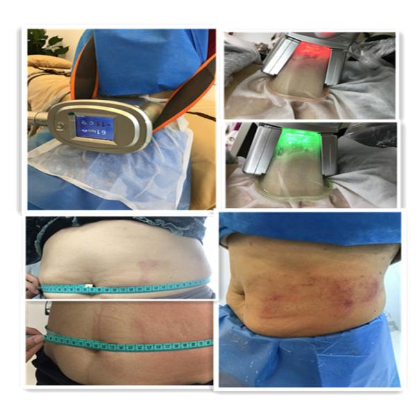 Домашняя машина Cryo жирная замерзая для тела уменьшая потерю веса