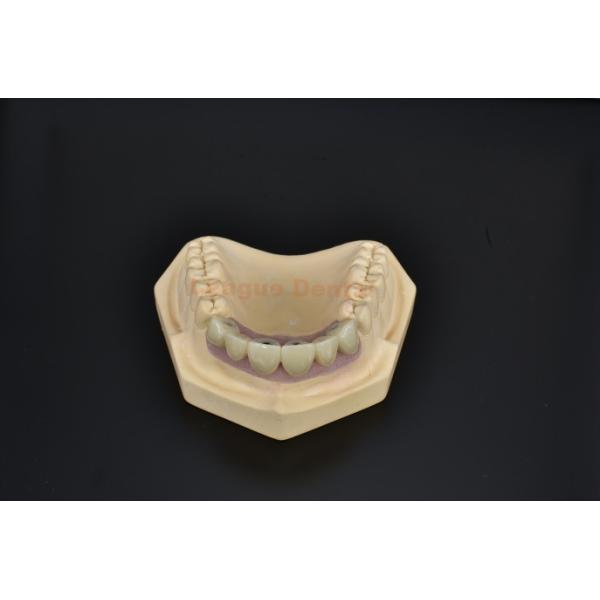 Natural Titanium Dental Implant Bridge For Missing Teeth Replacement