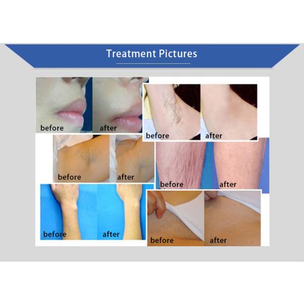 No burnning Non channel 808nm diode laser hair removal Machine no pain